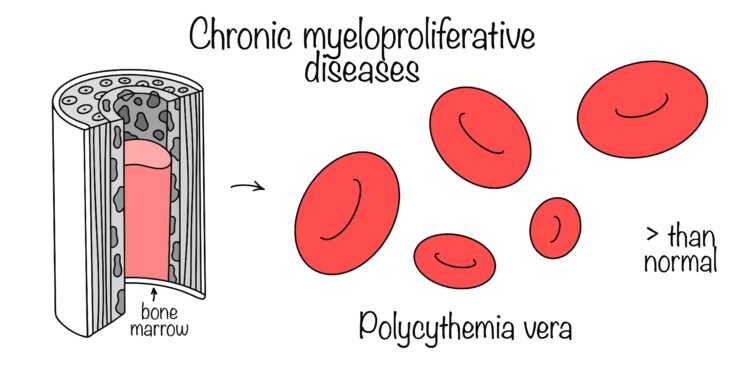 Policitemija vera: prognozė ir gyvenimo trukmė