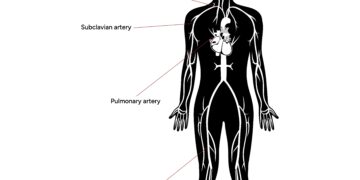 Brachialinis neuritas: skausmas, kurio nereikėtų ignoruoti