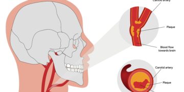 Krūtinės ir žandikaulio skausmas: ar tai širdies priepuolis?
