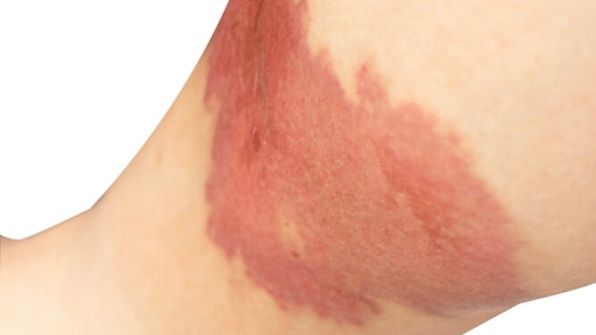 Svarbiausia žinoti apie diabetines pūsles