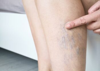 Kaip išvengti venų varikozės