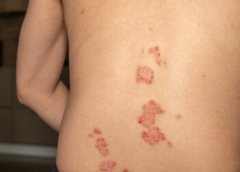 Kaip atskirti atvirkštinę psoriazę nuo intertrigo? Pagrindiniai simptomai ir jų atpažinimas