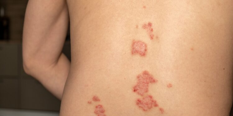 Kaip atskirti atvirkštinę psoriazę nuo intertrigo? Pagrindiniai simptomai ir jų atpažinimas