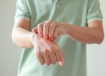 Ar biotinas veiksmingas gydant psoriazę?