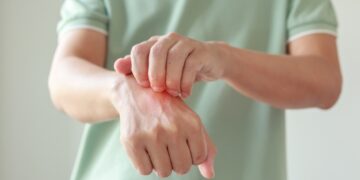 Ar biotinas veiksmingas gydant psoriazę?