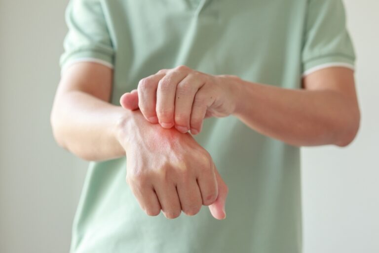 Ar biotinas veiksmingas gydant psoriazę?