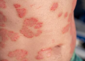 Ar galima atlikti masažą sergant psoriaze?