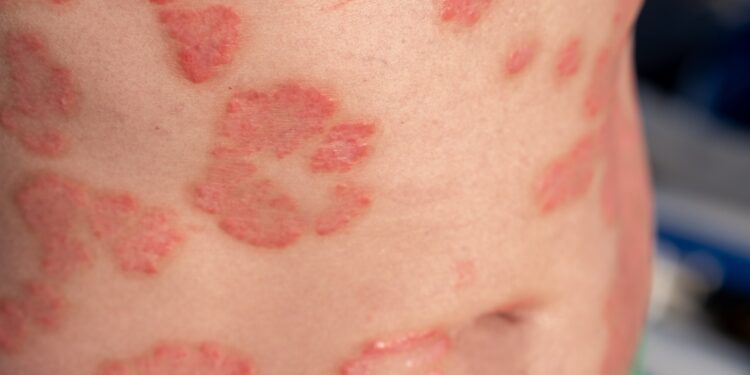 Ar galima atlikti masažą sergant psoriaze?