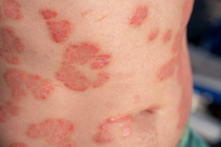 Ar galima atlikti masažą sergant psoriaze?