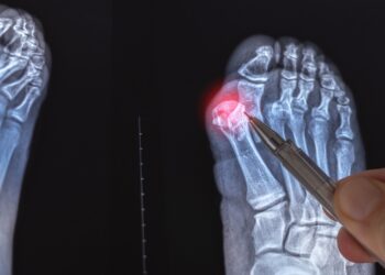 Didžiojo kojos piršto iškrypimai