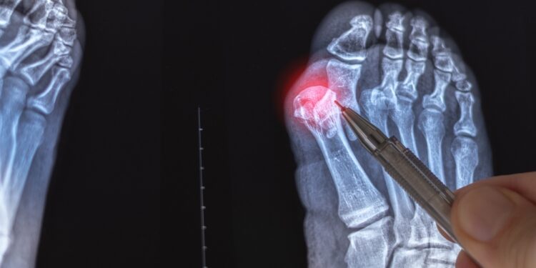 Pavadinimas „Bunions“ lietuviškai korektiškai verčiamas kaip **„Halluksai“** arba **„Didžiojo kojos piršto iškrypimai“**, priklausomai nuo konteksto:- Jei reikalingas medicininis ar techninis terminas, tinkamiausia būtų **„halluksai“** arba **„halluksas valgus“**.- Jei pavadinimas skirtas plačiajai visuomenei ar populiariajam turiniui, natūraliau skambėtų **„Didžiojo kojos piršto iškrypimai“** arba **„Kojų kauliukai“** (taip neretai vadinami liaudiškai).Pasirinkite variantą pagal pageidaujamą kontekstą.