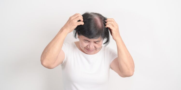 Seborėjinio dermatito ir plaukų slinkimo sąsaja