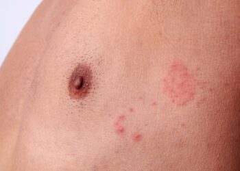 Kodėl vyrams pasirodo išskyros iš spenelių?