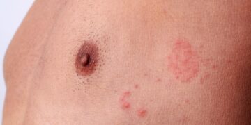 Kodėl vyrams pasirodo išskyros iš spenelių?