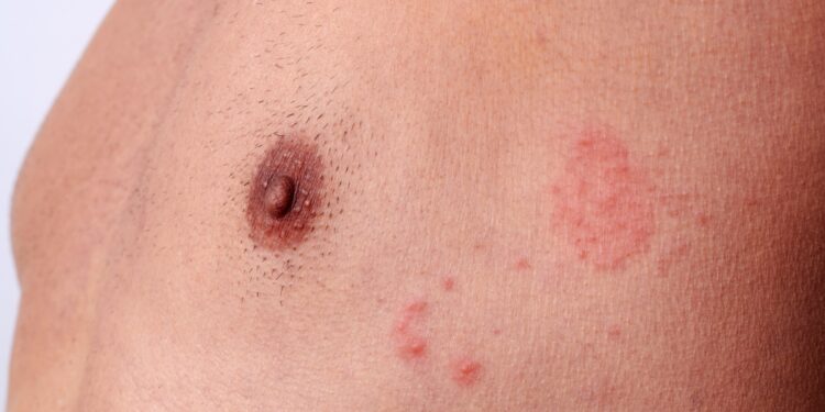 Kodėl vyrams pasirodo išskyros iš spenelių?