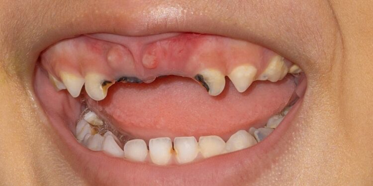 Dantų emalio erozija