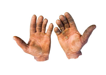 Ar įmanoma turėti plaukų delnuose?