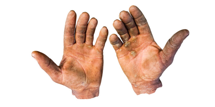 Ar įmanoma turėti plaukų delnuose?