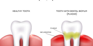 Bulimijos poveikis dantų sveikatai