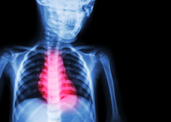 nestubulinis miokardo infarktas