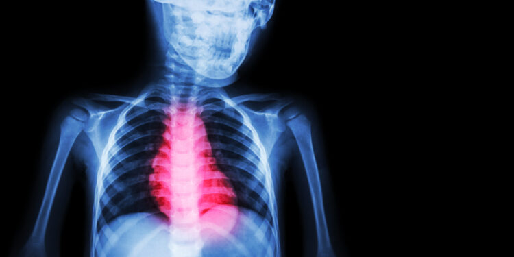 nestubulinis miokardo infarktas