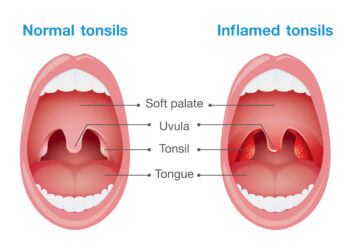 Viskas, ką reikia žinoti apie gerklės dirginimą