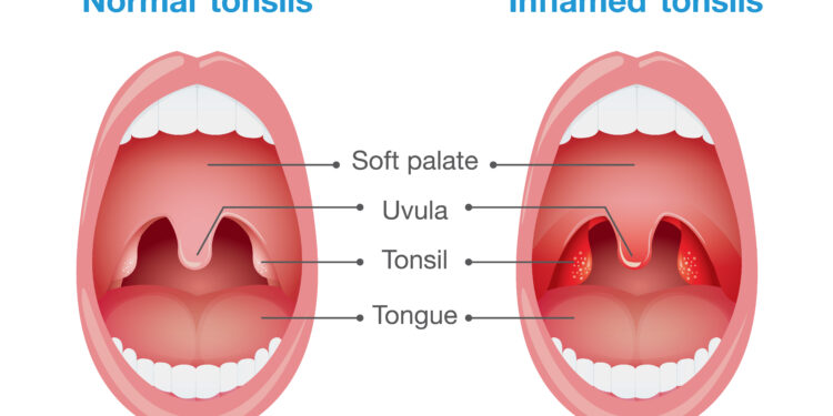 Viskas, ką reikia žinoti apie gerklės dirginimą