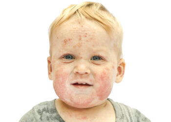 Kaip atrodo tymai (rubeola)?