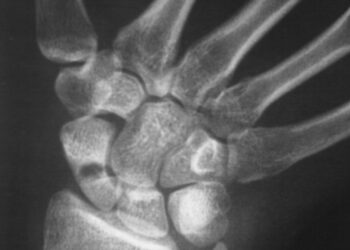 Alkūnkaulio stiloidinio ataugos lūžis