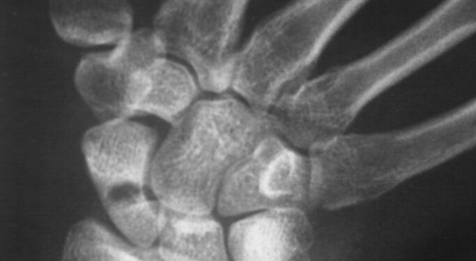 Alkūnkaulio stiloidinio ataugos lūžis