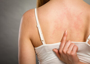 Ar policistinių kiaušidžių sindromas (PKS) gali sukelti dilgėlinę?