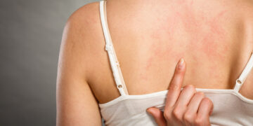 Ar policistinių kiaušidžių sindromas (PKS) gali sukelti dilgėlinę?