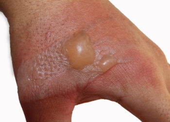 Kodėl po žiedu atsirado bėrimas?