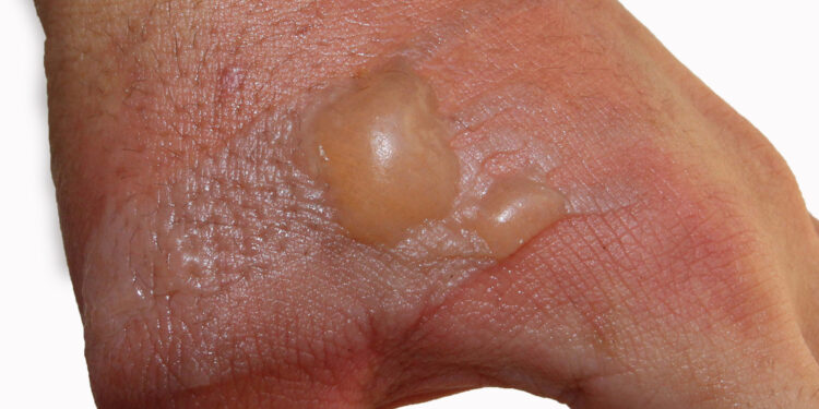 Kodėl po žiedu atsirado bėrimas?