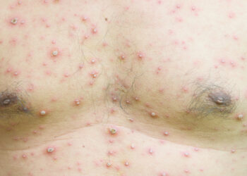 Kaip gydoma lašinė psoriazė?