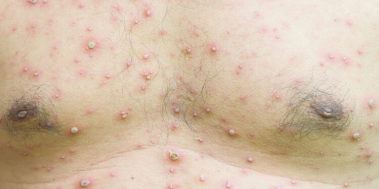 Kaip gydoma lašinė psoriazė?