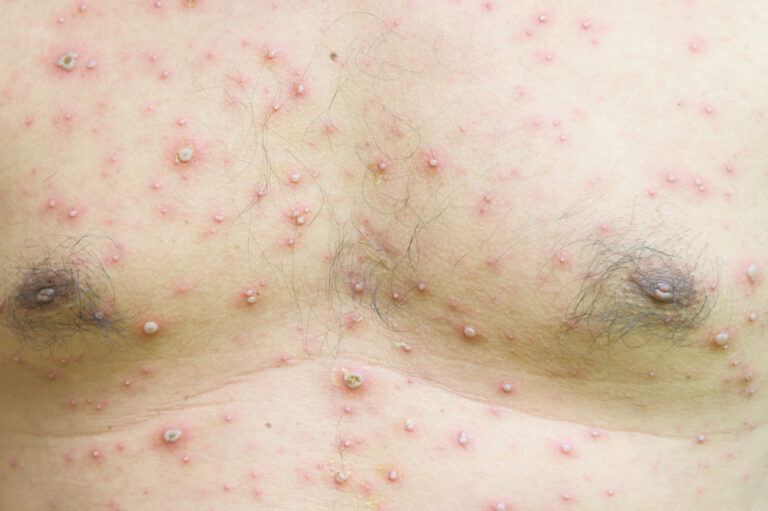 Kaip gydoma lašinė psoriazė?