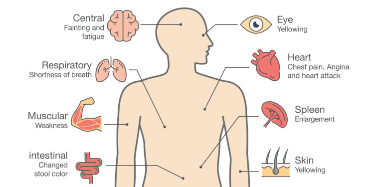 Ar yra skirtumas tarp LOPL ir emfizemos?