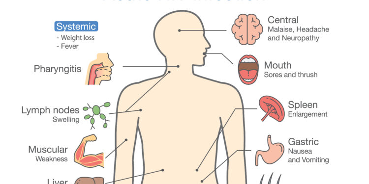 Padidėję limfmazgiai dėl ŽIV