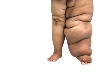 Kas yra elefantiazė?