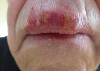 Kuo skiriasi MRSA infekcija nuo paprasto spuogo?