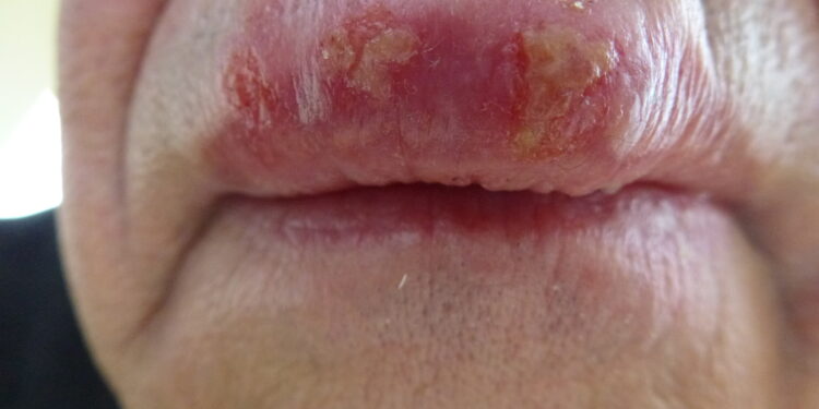 Kuo skiriasi MRSA infekcija nuo paprasto spuogo?