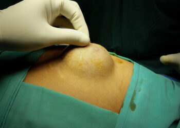 Bartholino liaukos cista