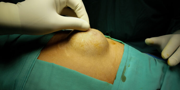 Bartholino liaukos cista