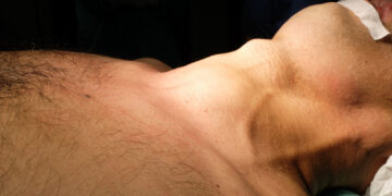 Kas yra BRAF teigiamas skydliaukės vėžys?