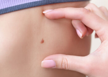 Kaip atpažinti ir gydyti mėlynąjį apgamą