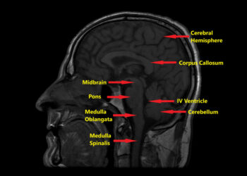 Kodėl mano vaikas gimė be didžiosios smegenų jungties (corpus callosum)?