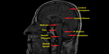 Kodėl mano vaikas gimė be didžiosios smegenų jungties (corpus callosum)?