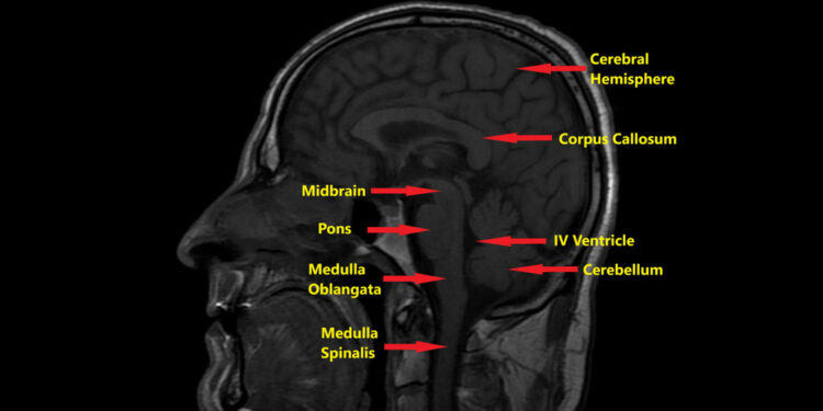 Kodėl mano vaikas gimė be didžiosios smegenų jungties (corpus callosum)?