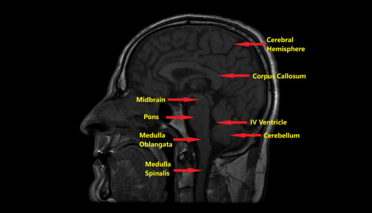 Kodėl mano vaikas gimė be didžiosios smegenų jungties (corpus callosum)?